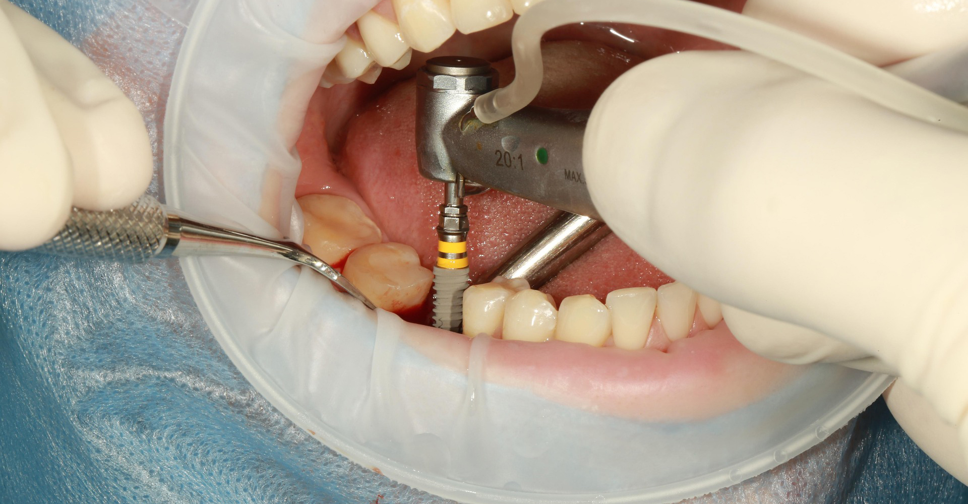 dental implant
