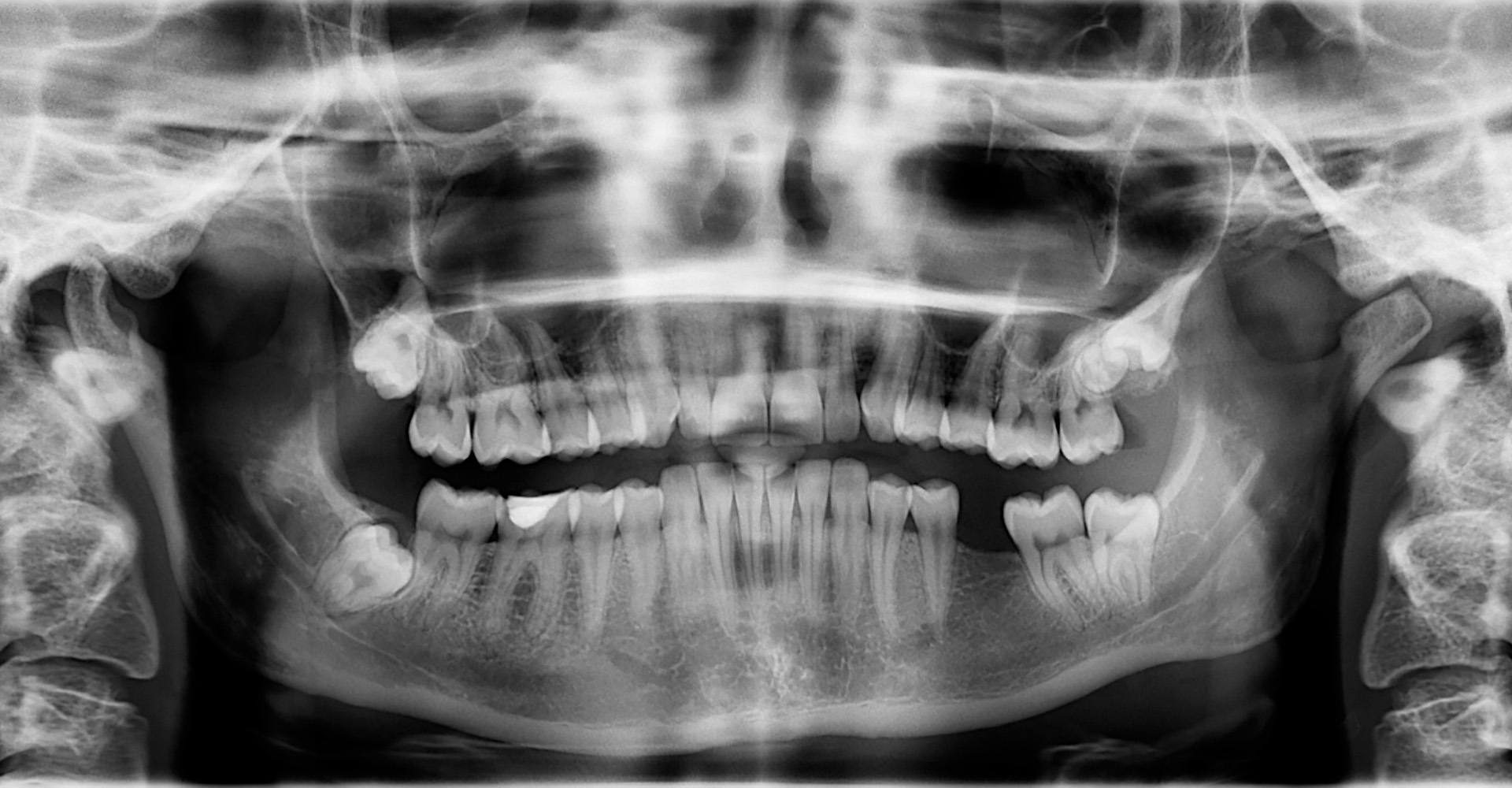 dental implant